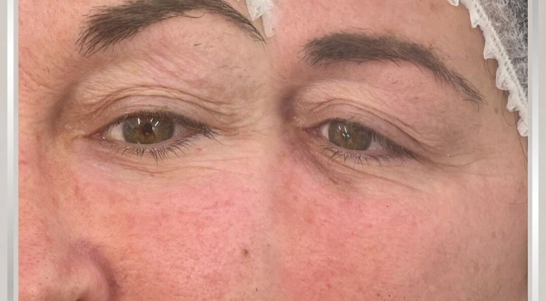 Close-up before and after eye rejuvenation at Eye Me Up Aesthetics, Rainham, England, GB.