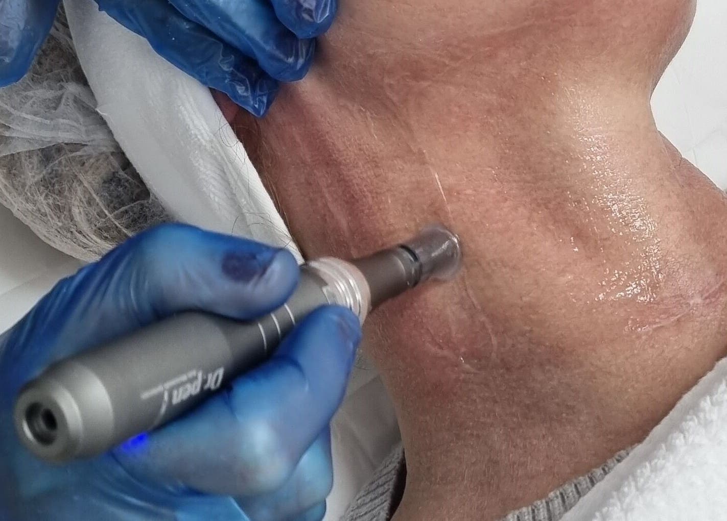Neck microneedling treatment at Unify Skin & Laser Clinic in Bathurst, New South Wales, AU for radiant results.