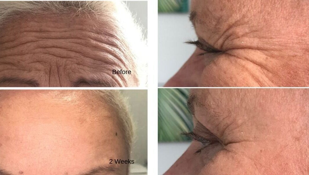Before and after wrinkle treatment at 176 Princes Street, Dunedin 9016, Dunedin, Otago Region, NZ.