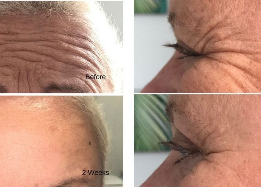 Before and after wrinkle treatment at 176 Princes Street, Dunedin 9016, Dunedin, Otago Region, NZ.