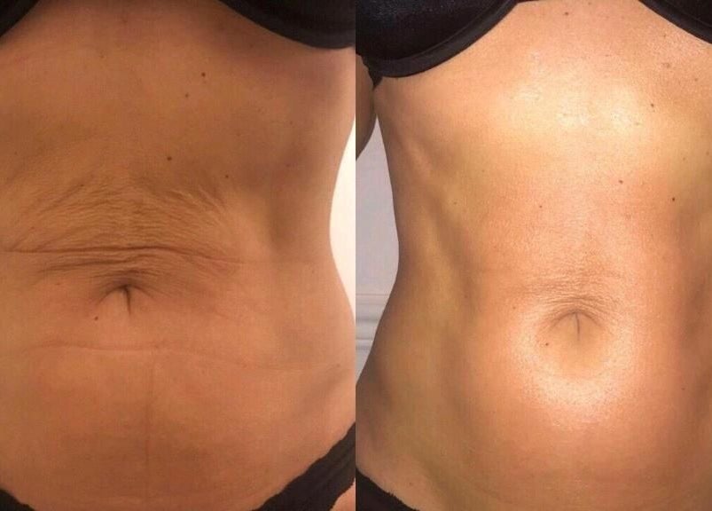 Before and after skin treatment at Sculptor Aesthetics, Edgware, England, GB showcasing skin texture improvement.