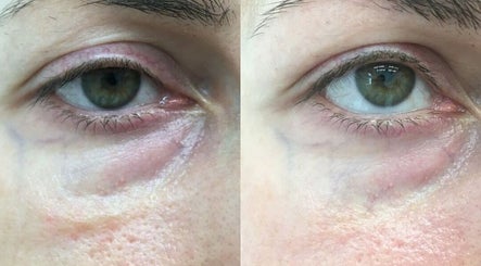MESOTHERAPIQUE, bilde 3