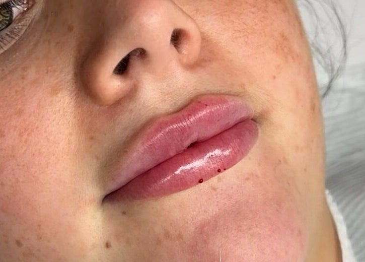 Close-up of lip enhancement at Sculpt Nails & Aesthetics, Warrington, England, GB.