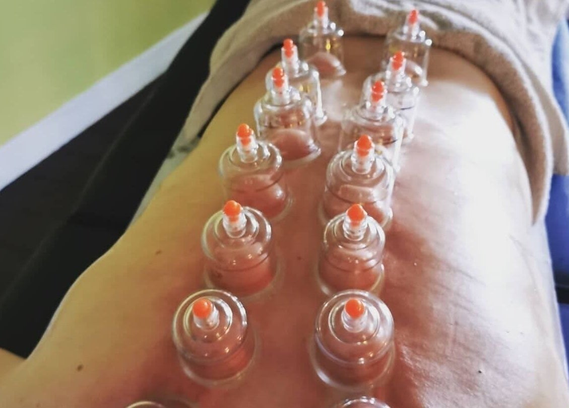 Cupping therapy at Macroom Massage and Holistic Clinic, County Cork, County Cork, IE. Healing and relaxation.