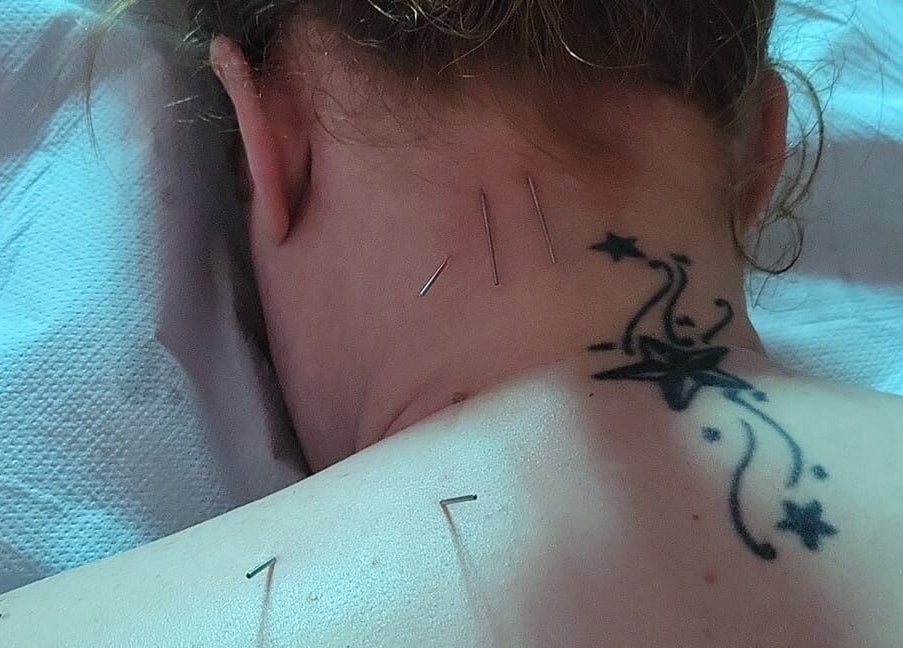 Acupuncture service at Macroom Massage and Holistic Clinic, County Cork, County Cork, IE. Relax and rejuvenate.