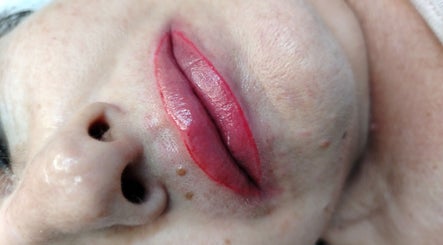 Lip enhancement procedure at Lavi Beauty Clinic, Pretoria, Gauteng, ZA showcasing precise application.