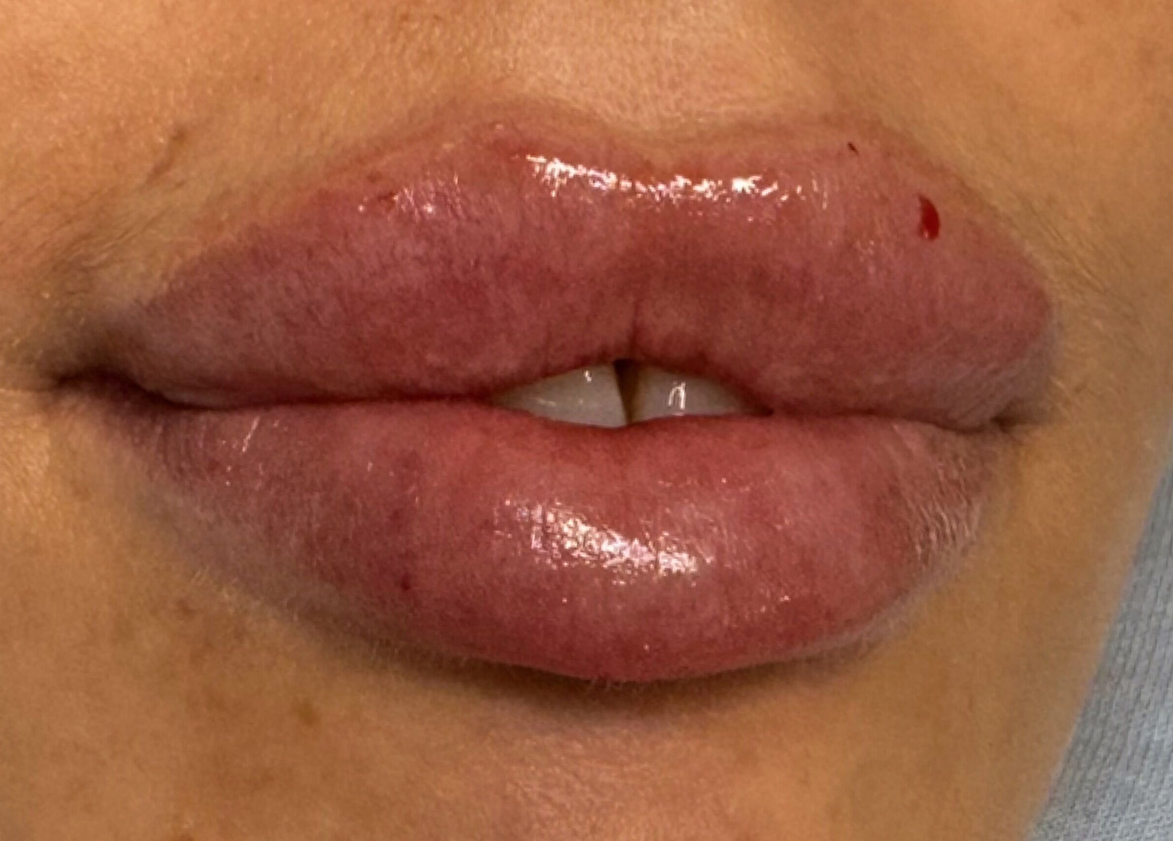 Enhanced lips at On The Lash Aesthetics, Wincanton, England, GB, showcasing expert beauty treatments.