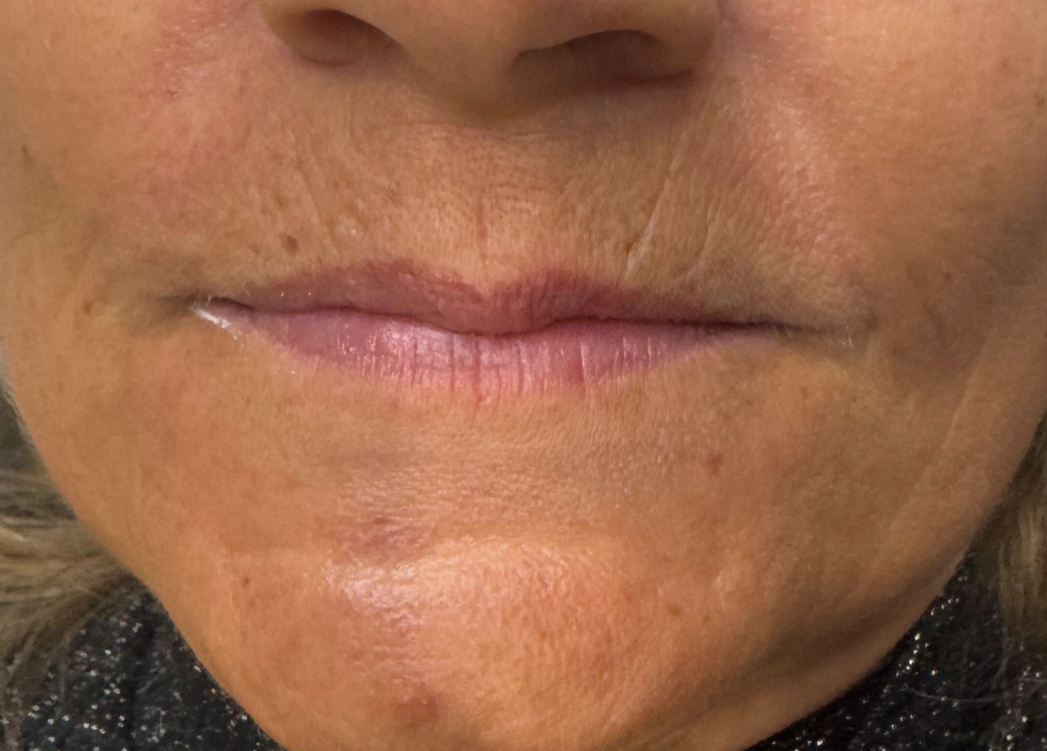 Close-up of a client's lower face post-treatment at On The Lash Aesthetics, Wincanton, England, GB.