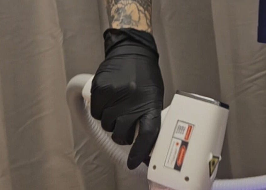 Χέρι με γάντι χειρίζεται συσκευή λέιζερ στο Valentina Beauty, Ακλαντζια, Λευκωσία, Κύπρος.