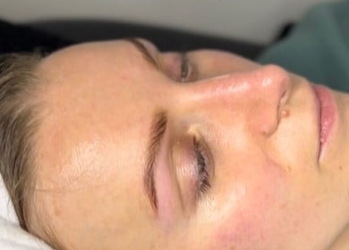 Close-up of a serene face undergoing a skin treatment at Shxdy Skin Clinic, Manchester, England, GB.
