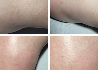 Before and after skin rejuvenation at LBeauty, Limerick, County Limerick, IE.