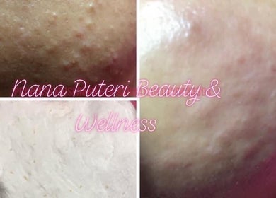 Close-up of skin treatment at Nana Puteri Beauty and Wellness in Sandakan, Sabah, MY, showcasing improved texture.