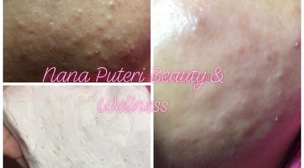 Close-up of skin treatment at Nana Puteri Beauty and Wellness in Sandakan, Sabah, MY, showcasing improved texture.
