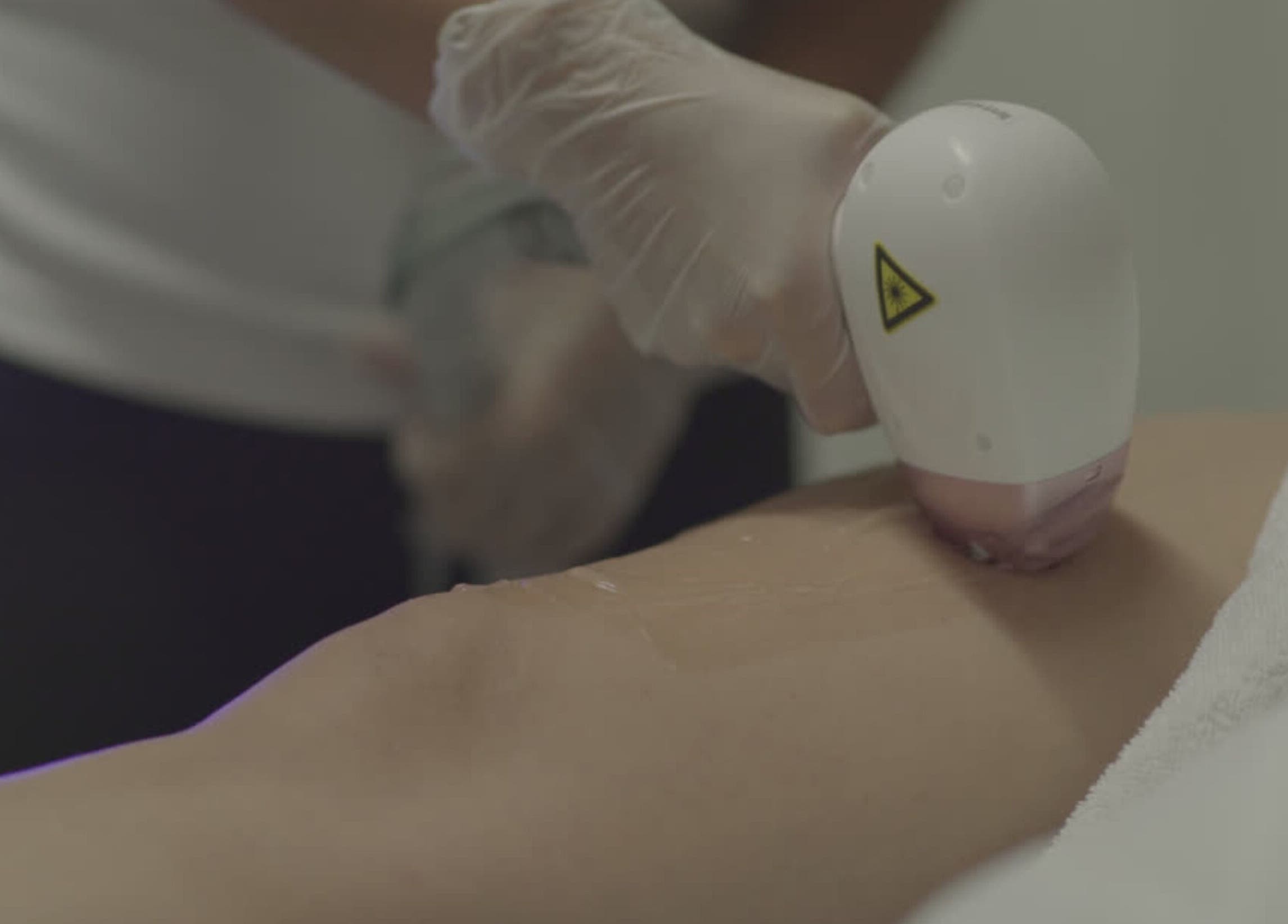 Tratamiento de depilación láser en Magic Estética y Spa, San José, San José, CR.