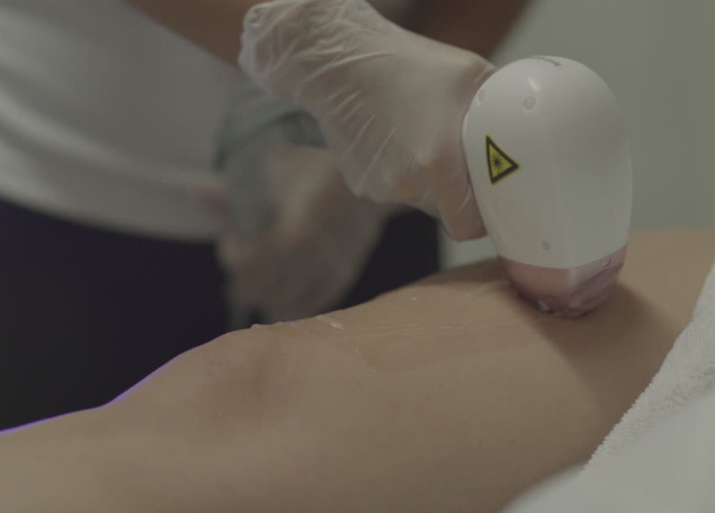 Tratamiento de depilación láser en Magic Estética y Spa, San José, San José, CR.