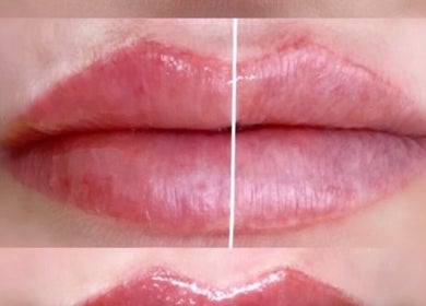 Lip enhancement before and after at Sian Carrie Studio, Chelmsford, England, GB.