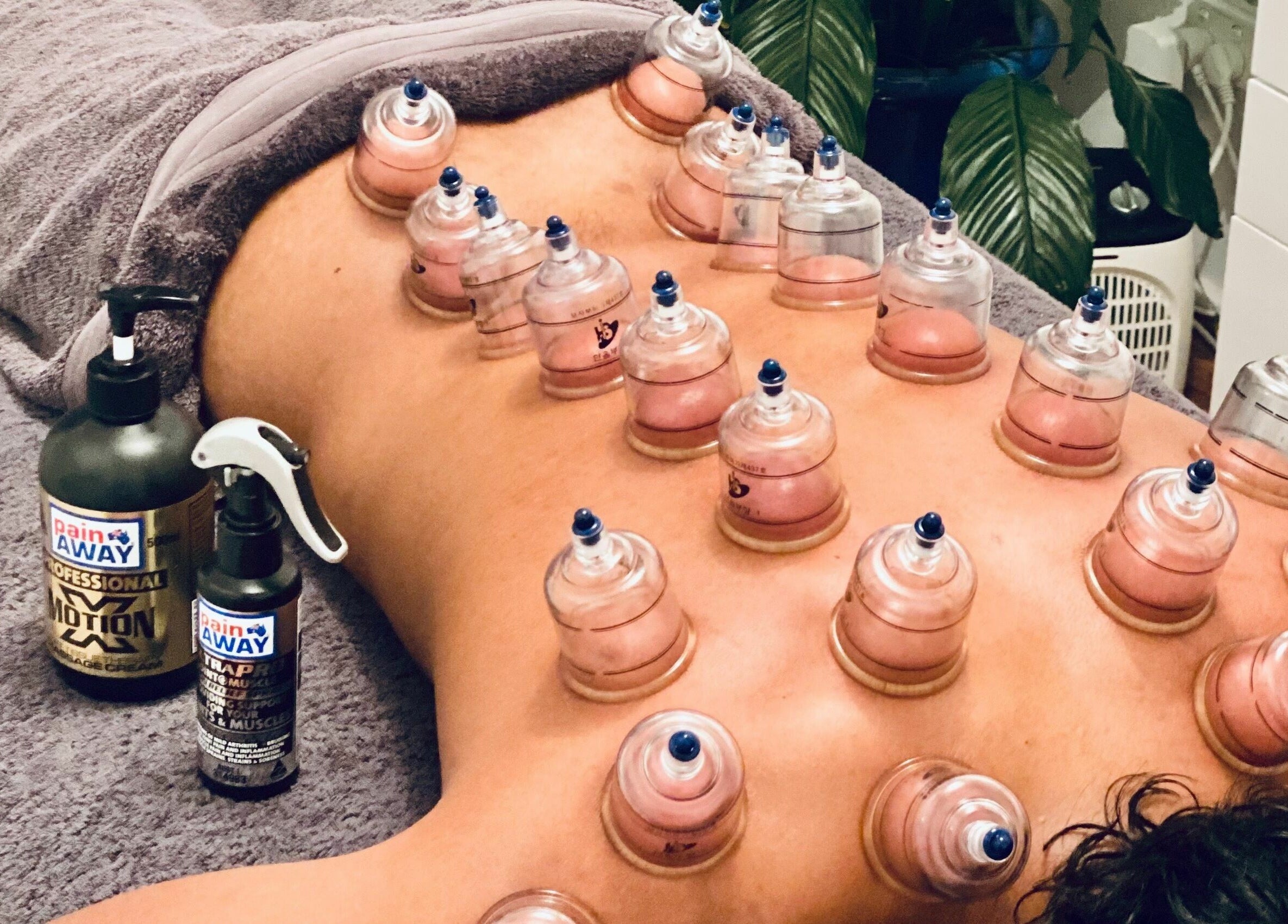 Cupping therapy session at Cindy’s Remedial Massage, Shellharbour, New South Wales, AU, promoting wellness.