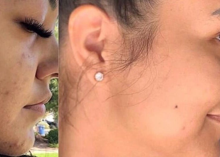 Before and after facial treatment at Touch & Glow Aesthetics Lounge, Vacoas-phœnix, Plaines Wilhems, MU.