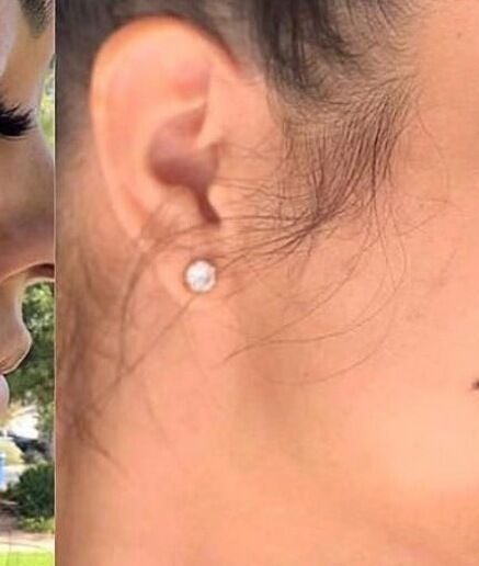 Before and after facial treatment at Touch & Glow Aesthetics Lounge, Vacoas-phœnix, Plaines Wilhems, MU.