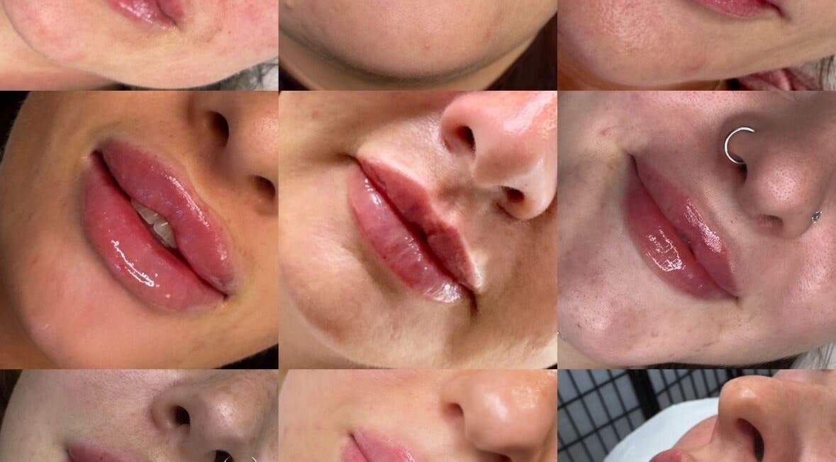 Luscious lip enhancements at Dream Face by Tess Studio, Manea, England, GB. Explore expert lip treatments.