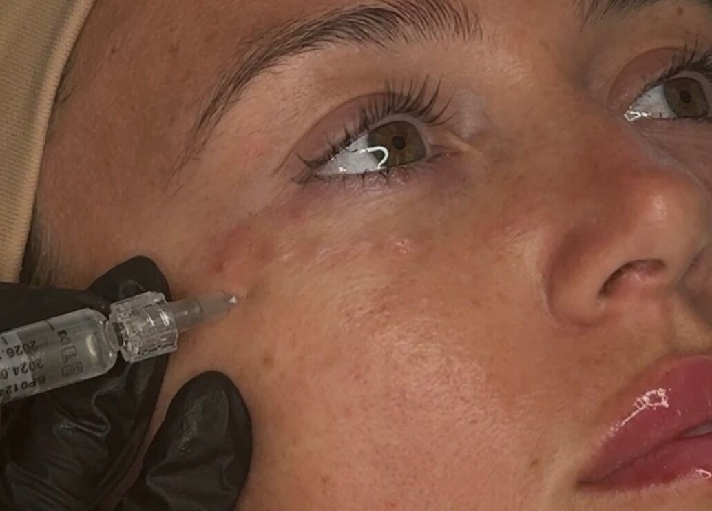 Facial aesthetic treatment at Ewelina Jakubus Aesthetics, Harlow, England, GB. Close-up of injection near eye.