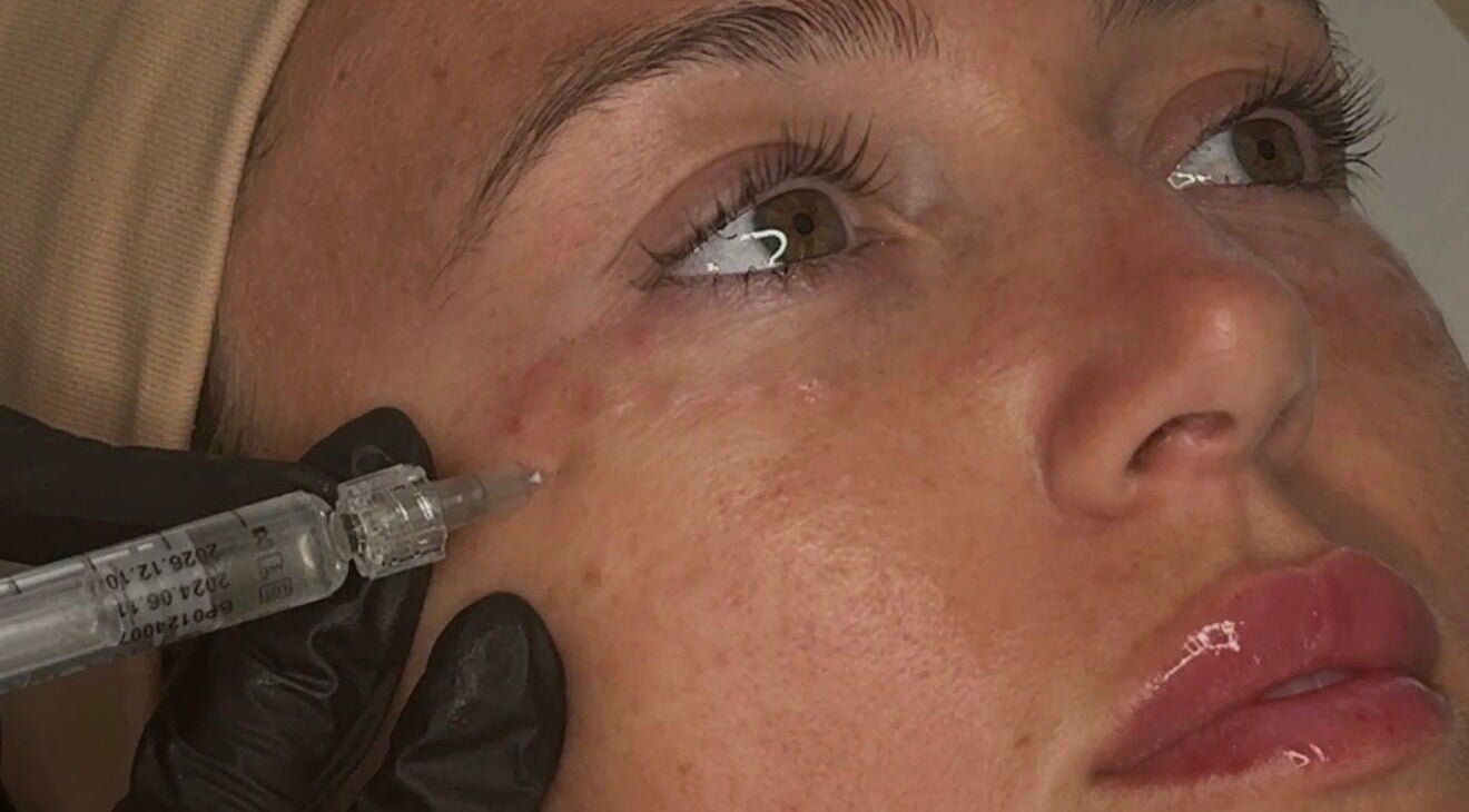 Facial aesthetic treatment at Ewelina Jakubus Aesthetics, Harlow, England, GB. Close-up of injection near eye.