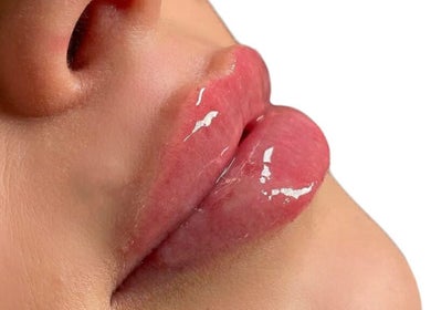 Close-up of glossy lips at Chelski-Aesthetics, London, England, GB, showcasing lip treatment.