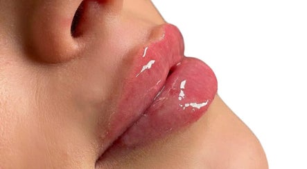 Close-up of glossy lips at Chelski-Aesthetics, London, England, GB, showcasing lip treatment.