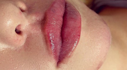 Close-up of glossy lips treated at Chelski-Aesthetics, London, England, GB showcasing vibrant lip care.