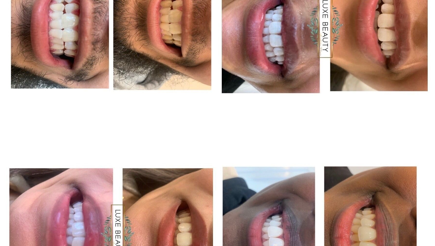 Close-up of beaming smiles after treatment at Luxe Beauty, London, England, GB, showcasing dental care results.