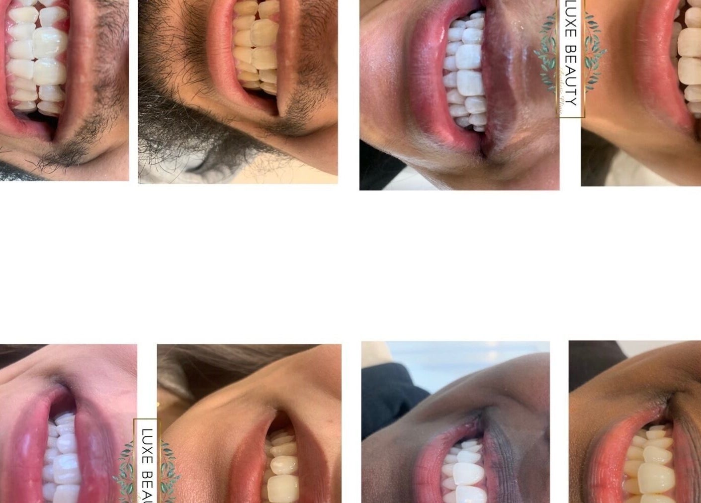 Close-up of beaming smiles after treatment at Luxe Beauty, London, England, GB, showcasing dental care results.