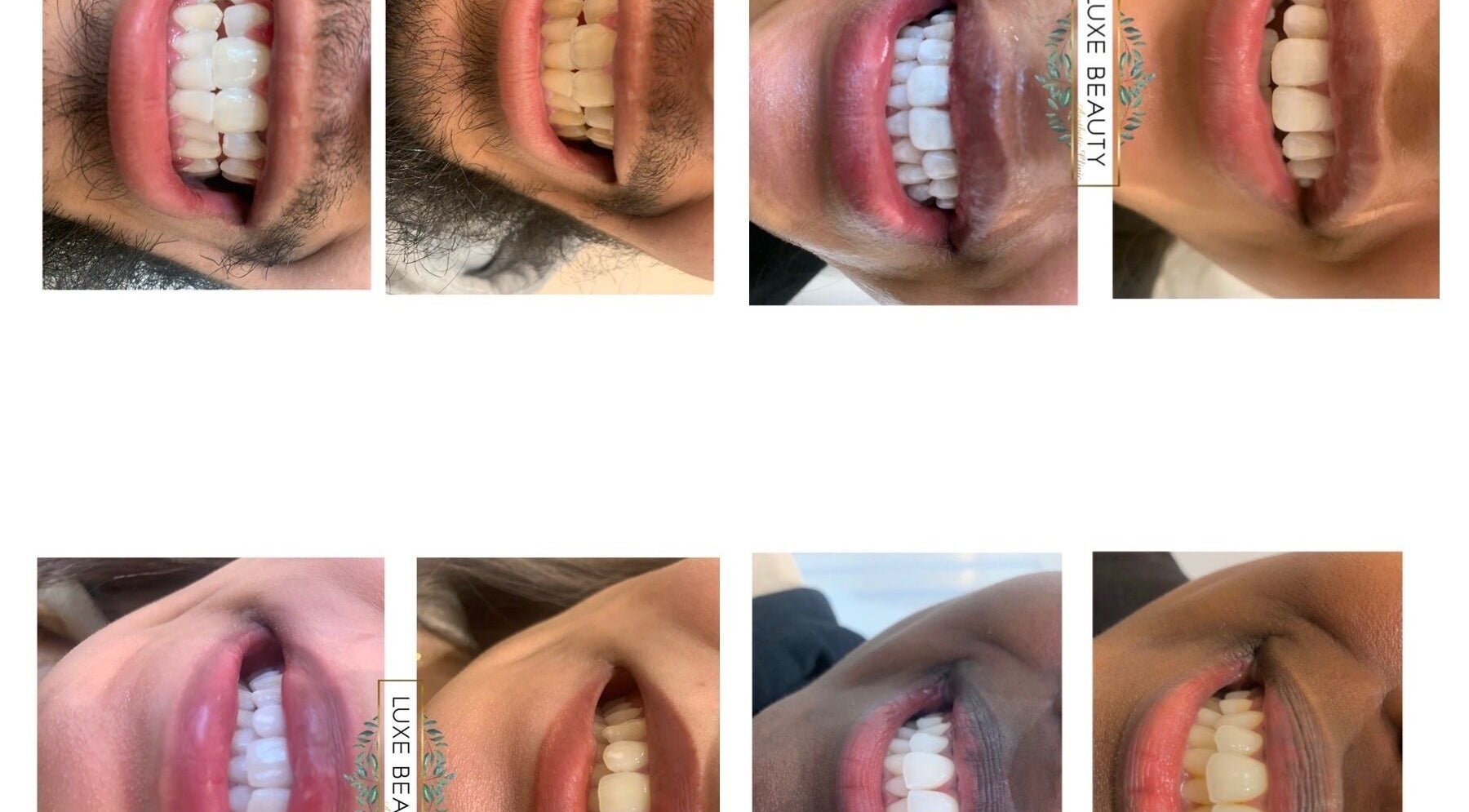 Close-up of beaming smiles after treatment at Luxe Beauty, London, England, GB, showcasing dental care results.