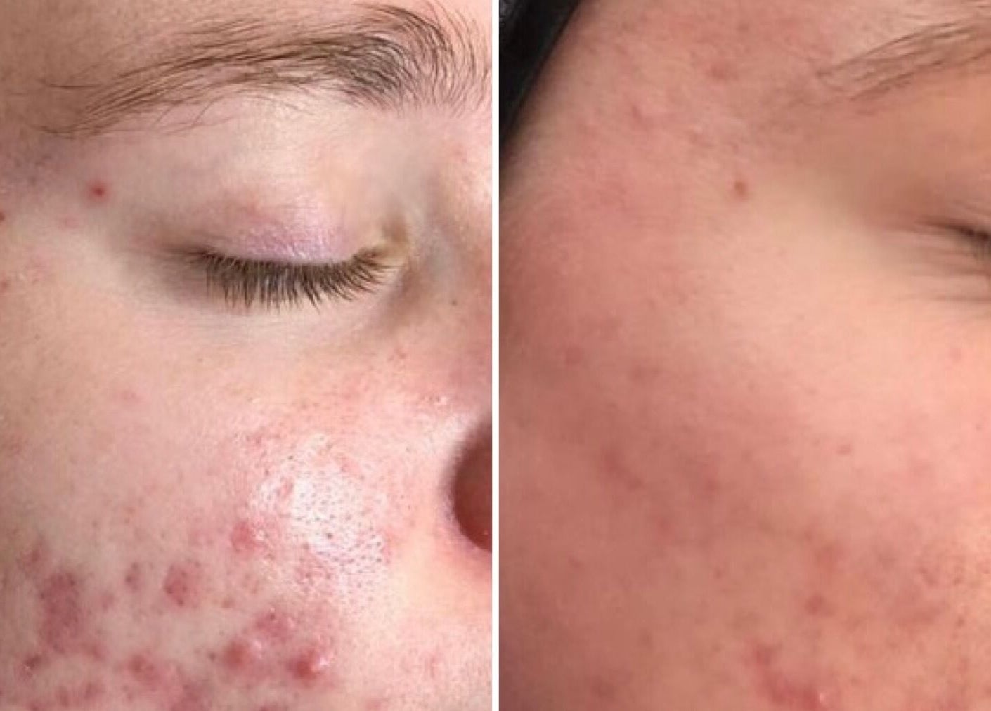 Before and after acne treatment at Luxe Beauty, London, England, GB, showcasing clear skin results.