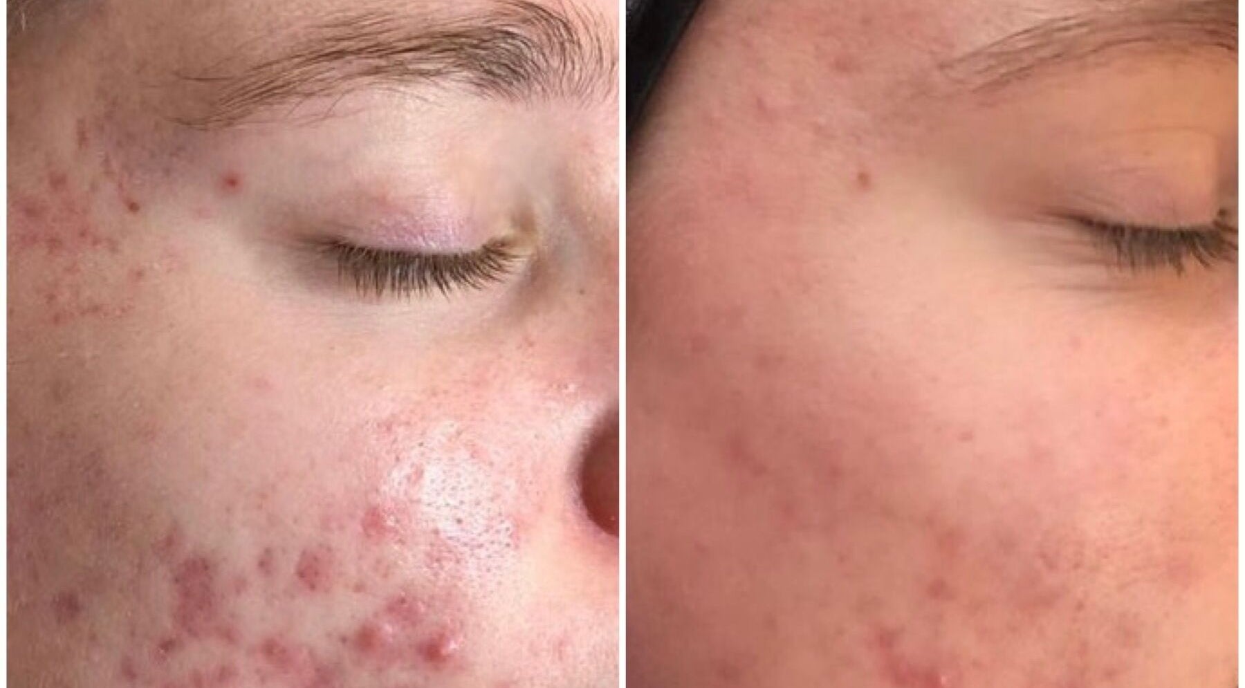 Before and after acne treatment at Luxe Beauty, London, England, GB, showcasing clear skin results.