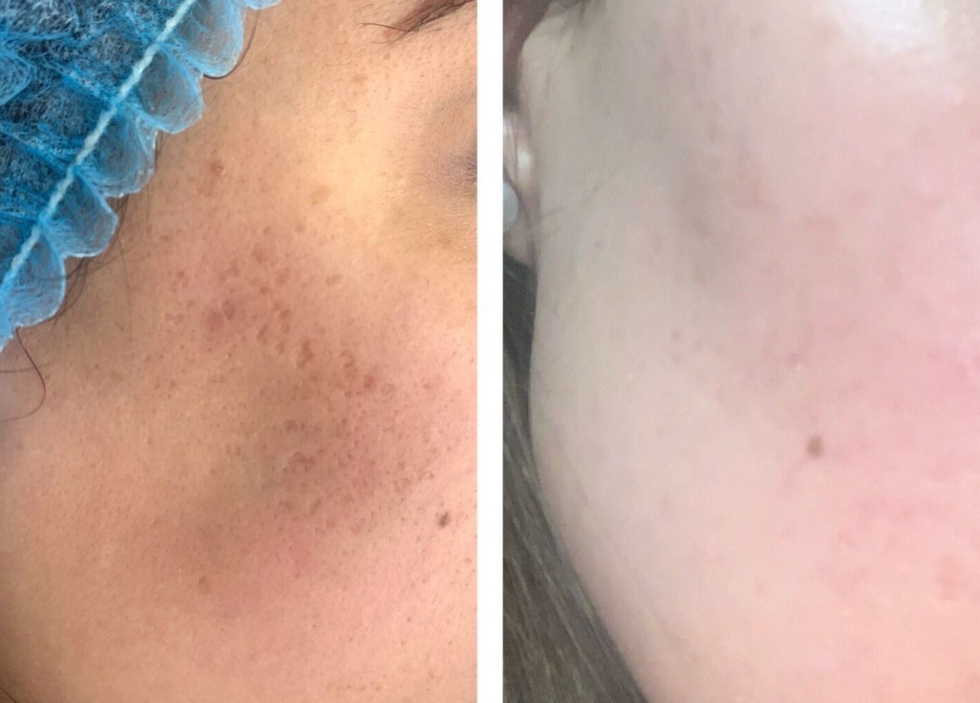 Before and after skincare treatment at Luxe Beauty, London, England, GB showing clear skin results.