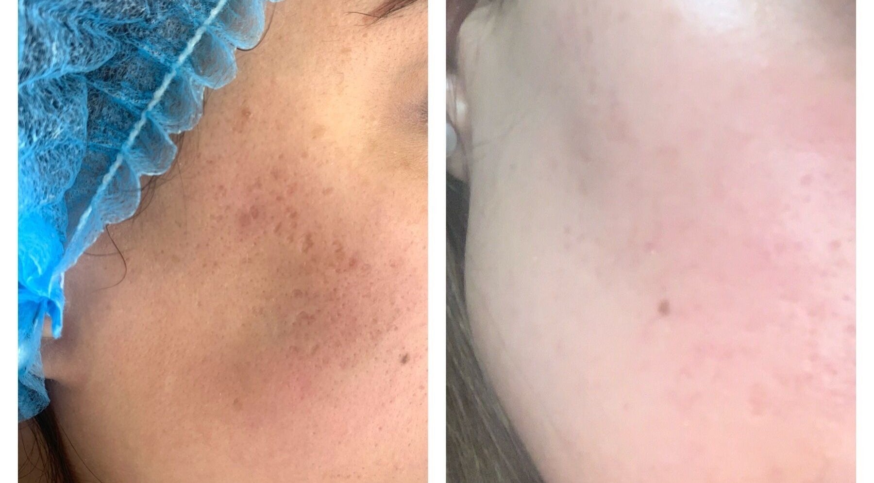 Before and after skincare treatment at Luxe Beauty, London, England, GB showing clear skin results.