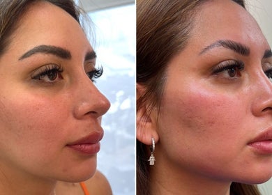Tratamiento facial en Biosense Clinica Laser - La Molina, mejora visible. Ubicada en La Molina, Provincia De Lima, PE.
