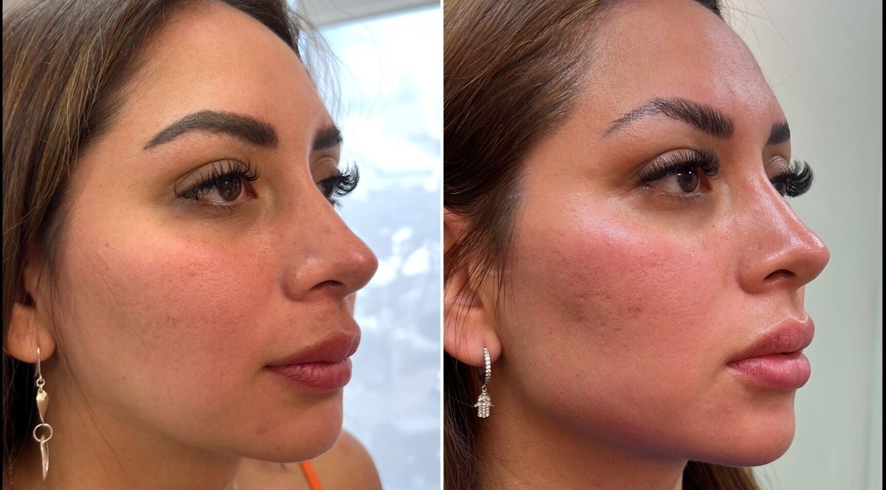 Tratamiento facial en Biosense Clinica Laser - La Molina, mejora visible. Ubicada en La Molina, Provincia De Lima, PE.