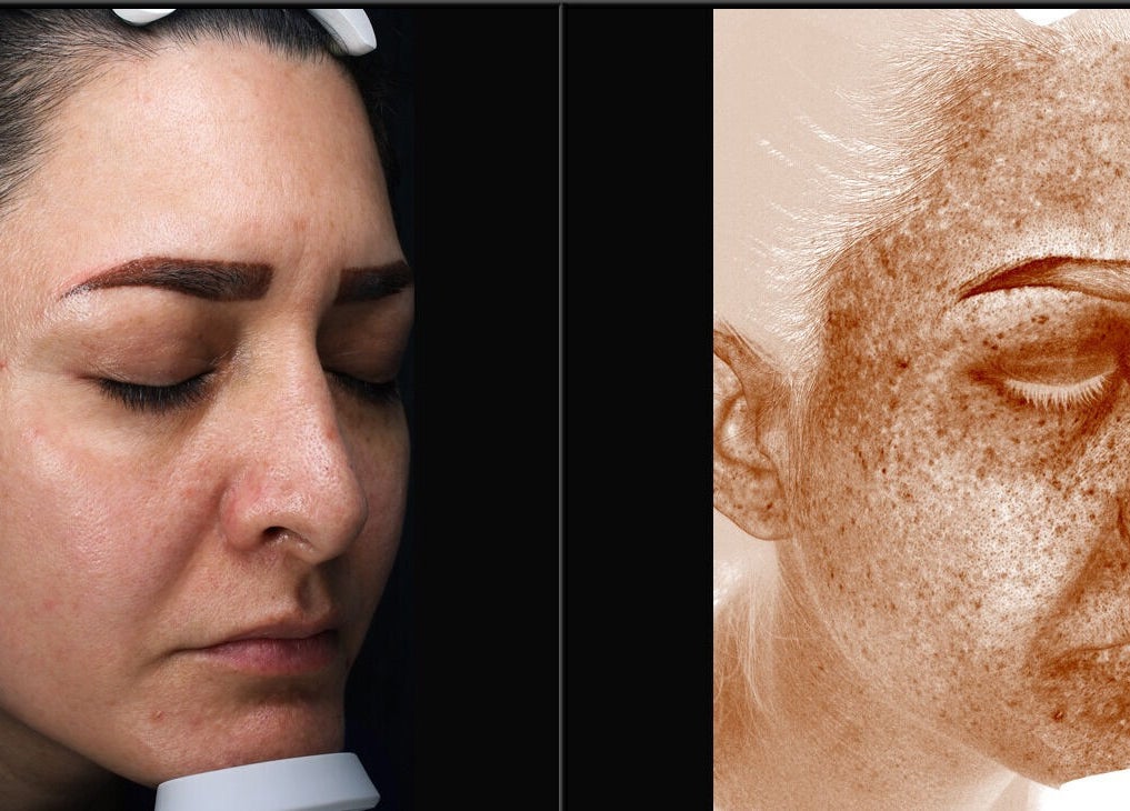 Análisis facial detallado en Biosense Clinica Laser - La Molina, La Molina, Provincia De Lima, PE.