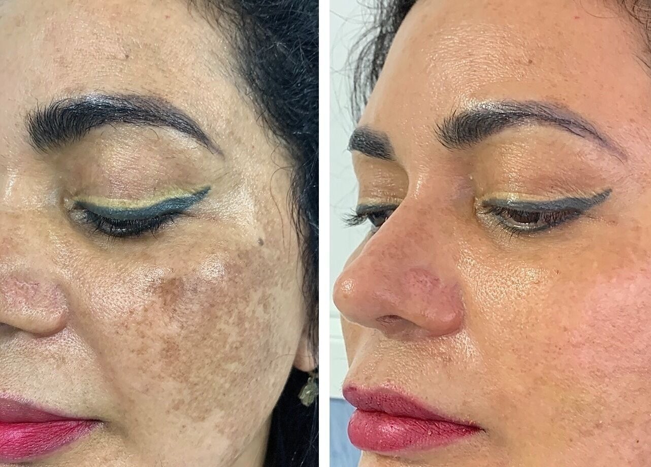 Tratamiento de manchas en Biosense Clinica Laser - La Molina, Provincia De Lima, PE.