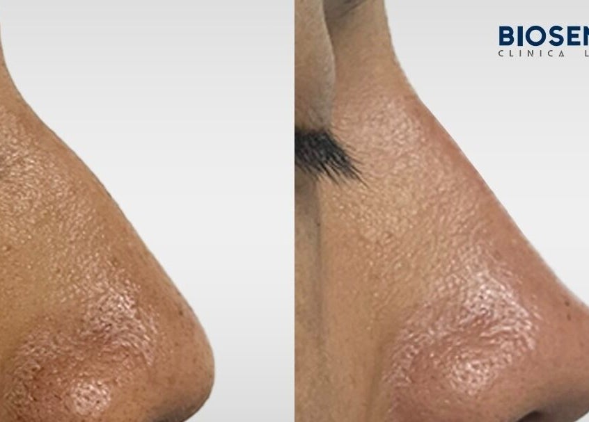 Antes y después de tratamiento nasal en Biosense Clinica Laser - La Molina, La Molina, Provincia De Lima, PE.