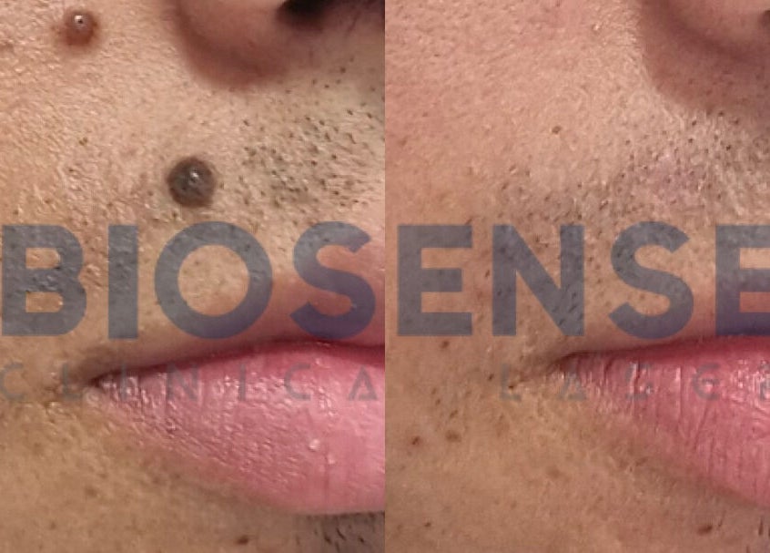 Antes y después de tratamiento en Biosense Clinica Laser - La Molina, La Molina, Provincia De Lima, PE.