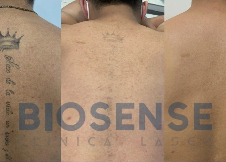 Tratamiento de eliminación de tatuajes en Biosense Clinica Laser - La Molina, Provincia De Lima, PE.