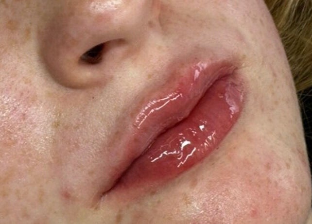 Smooth lip enhancement at Tiptoe Beauty and Aesthetic‘s, Nuneaton, England, GB, showcasing a glossy finish.