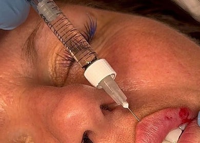 Lip enhancement procedure at Lous L.A.B, Tonbridge, England, GB offering specialized beauty treatments.