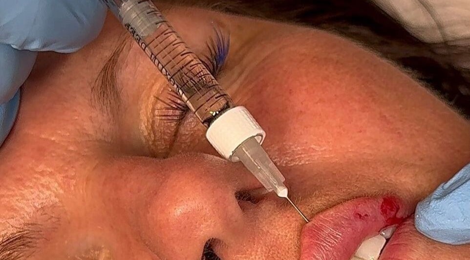 Lip filler treatment at Lous L.A.B, Tonbridge, England, GB for enhanced beauty and confidence.