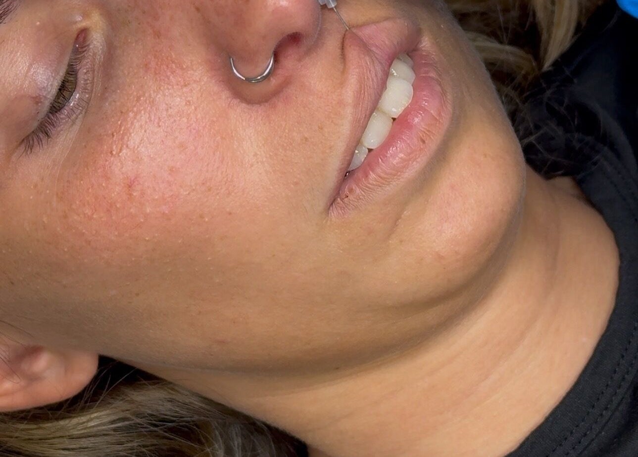 Close-up of a client's smooth skin after treatment at Lous L.A.B, Tonbridge, England, GB.