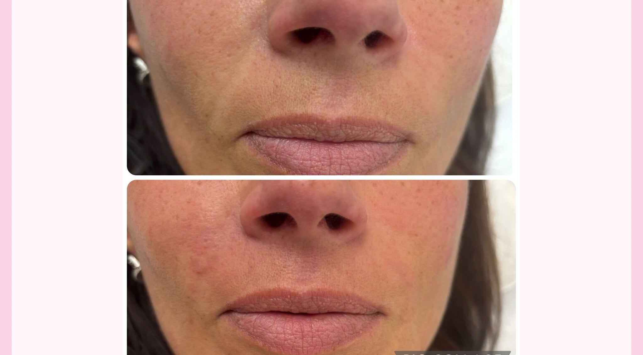 Before and after lip treatment at LHaesthestics, Swindon, England, GB showcasing fuller lips.