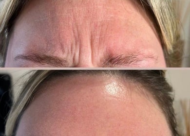 Forehead rejuvenation at Poise Studio, Rawmarsh, England, GB showcasing wrinkle reduction results.