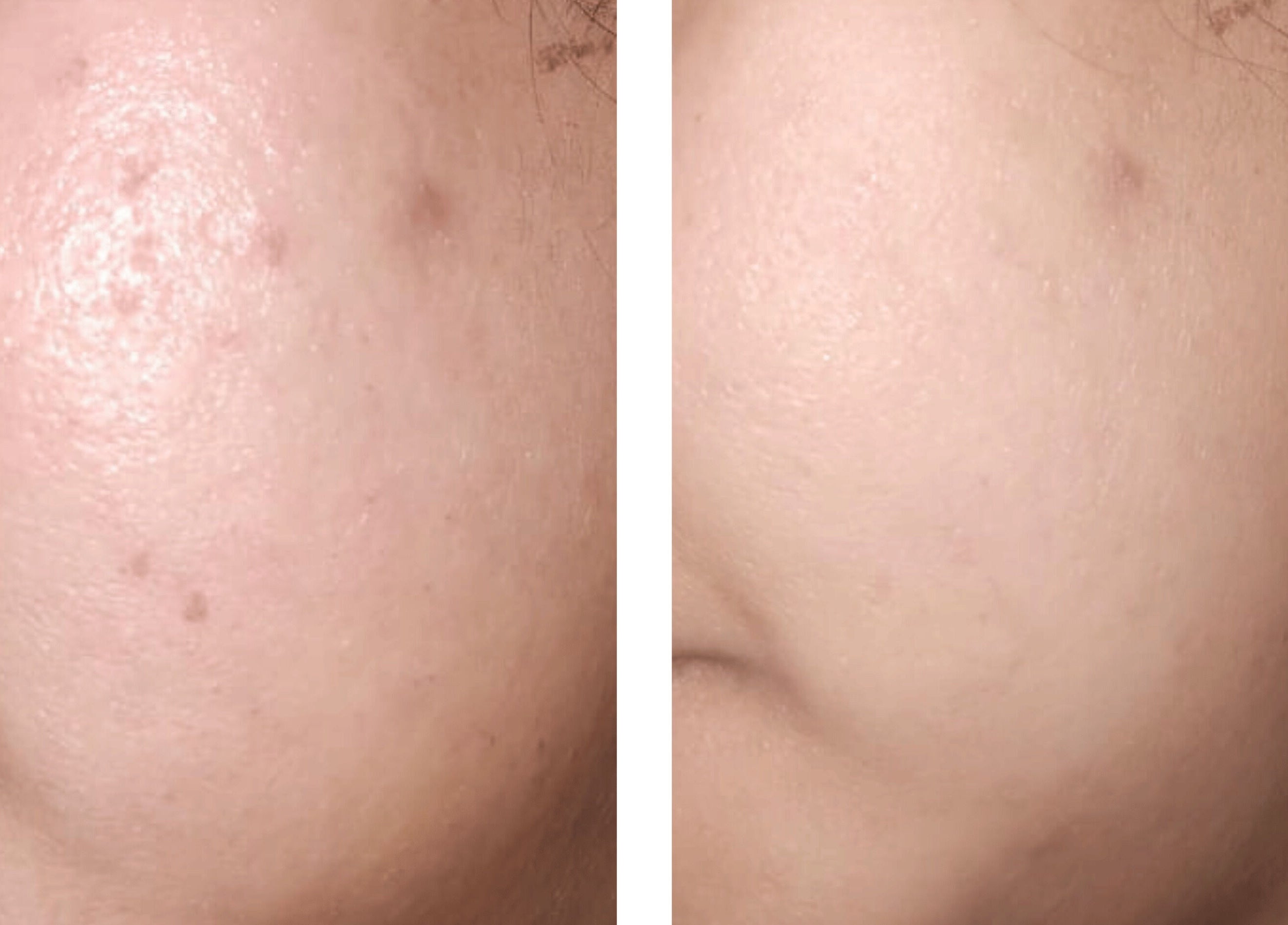 Clinical Skin Care results in Gasparillo, Couva-Tabaquite-Talparo, TT showing before and after skin improvement.